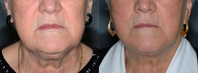 Empowering transformations: Liposuction for the neck