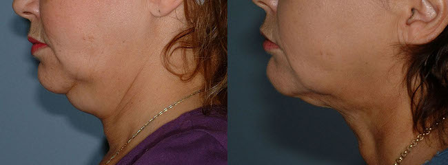 Radiant results from neck liposuction treatment