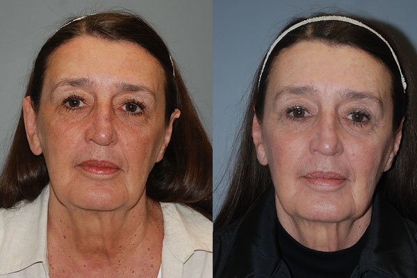 Refining ear contours: Otoplasty procedure