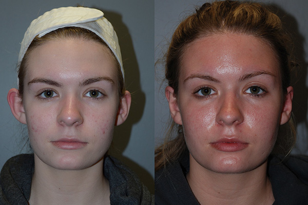 Crafting balanced profiles: Otoplasty transformation