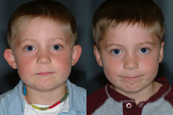 Sculpting confident silhouettes: Ear pinning surgery