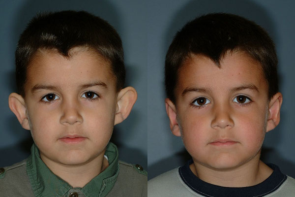 Precision techniques in otoplasty procedure