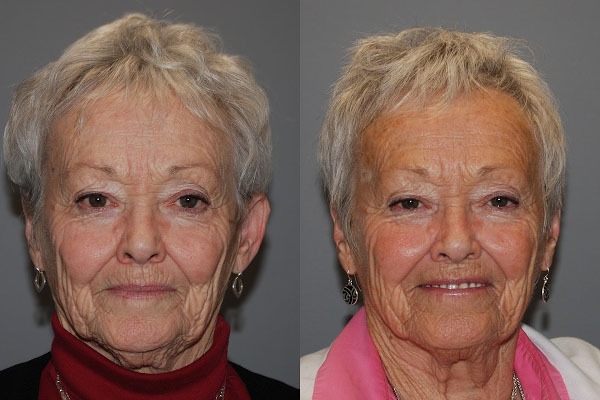 Empowering transformations: Otoplasty journey