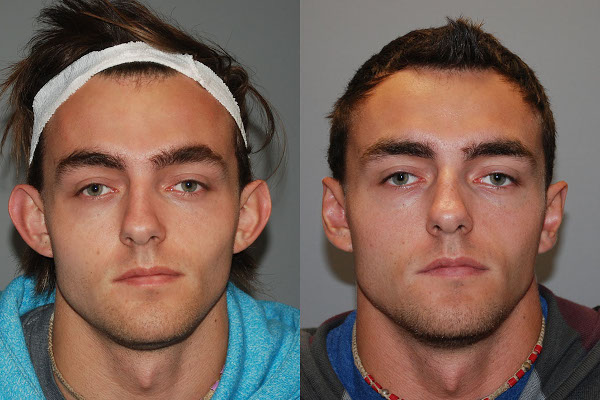 Artful precision in ear pinning surgery