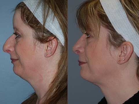 Crafting refined profiles: Rhinoplasty procedure
