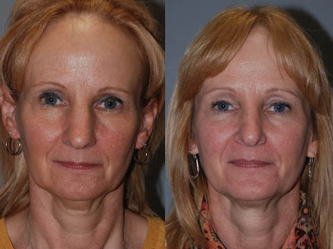 Sculpting nasal contours: Rhinoplasty surgery in progress