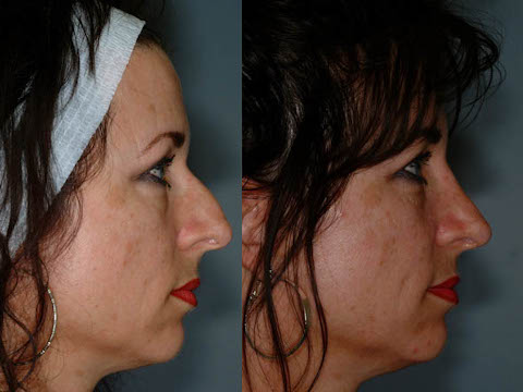 Precision techniques in rhinoplasty procedure
