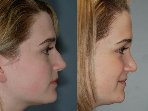 Enhancing facial harmony: Rhinoplasty transformation
