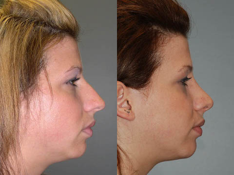 Empowering transformations: Rhinoplasty journey