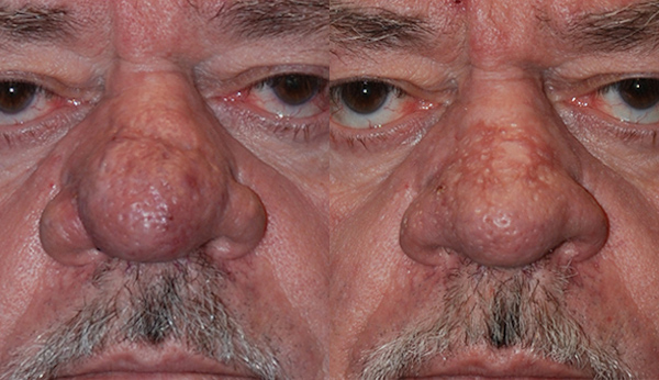 Addressing nasal concerns: Rhinophyma treatment