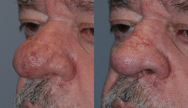 Transforming nasal contours: Rhinophyma correction
