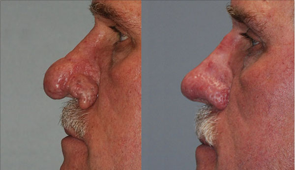 Crafting refined profiles: Rhinophyma procedure
