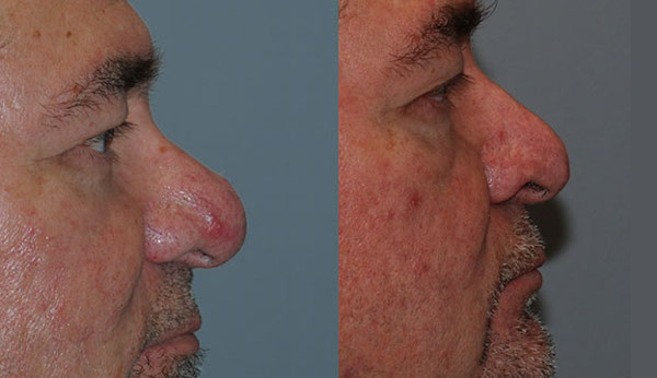 Precision techniques in rhinophyma treatment