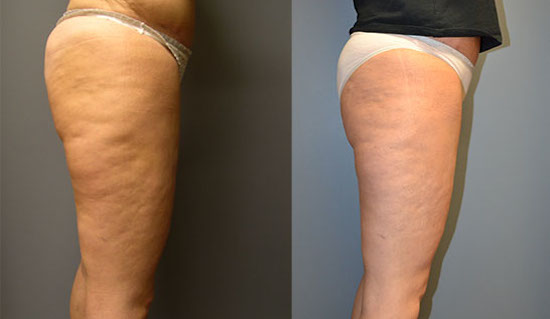 Enhancing thigh contours: Thigh lift procedure