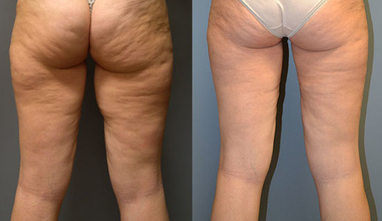 Refining lower body silhouette: Thigh lift surgery