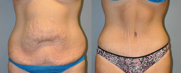 Sculpting a sleek silhouette: Abdominoplasty in progress
