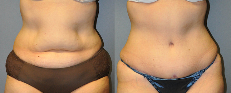 Enhancing abdominal appearance: Tummy tuck surgery