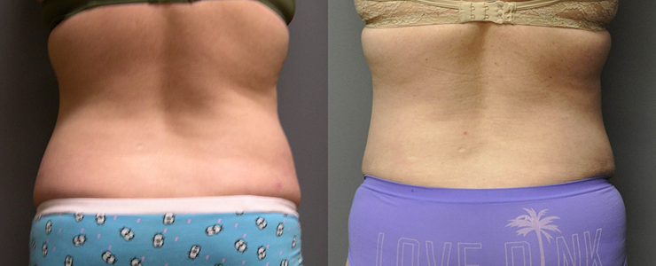 Crafting confidence: Abdominoplasty underway