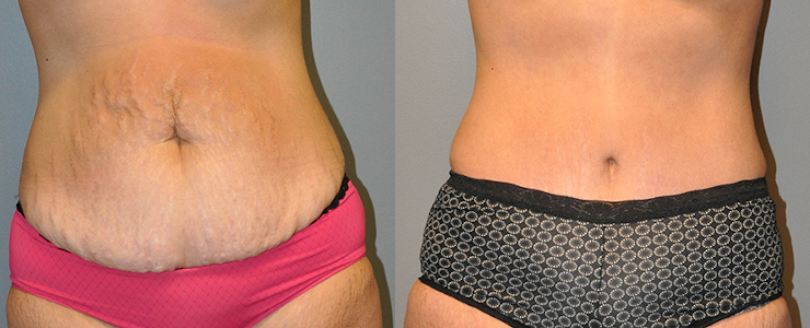 Transforming contours: Tummy tuck procedure
