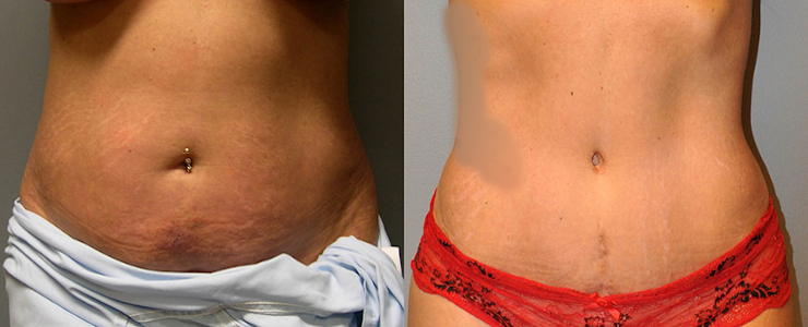 Empowering transformations: Tummy tuck experience
