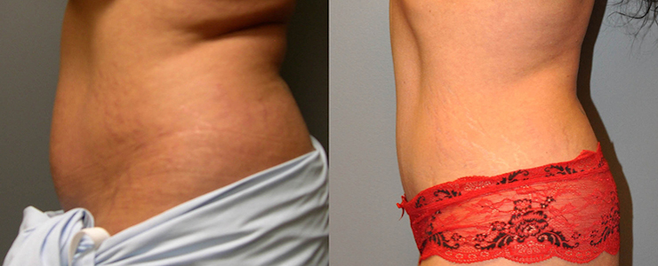 Artistic vision in abdominal contouring: Abdominoplasty