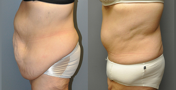 Empowering transformations: Weight loss journey