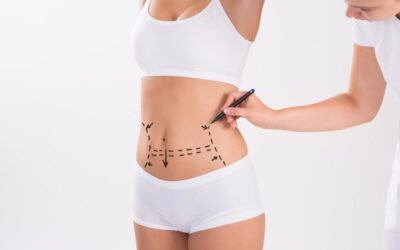 Considering Abdominoplasty After Weight Loss