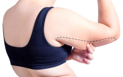Body Contouring After Weight Loss: Arm Lift Surgery