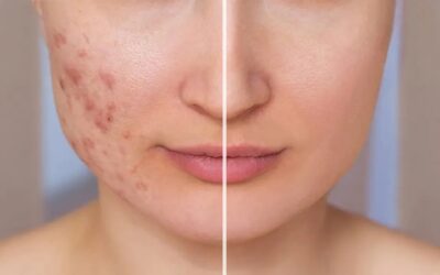 Scar Revision: Types of Scars and Their Treatments