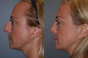 Septorhinoplasty