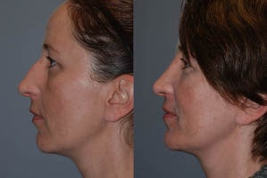 Septorhinoplasty