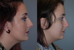 Septorhinoplasty