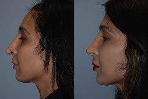 Septorhinoplasty