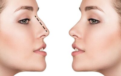 Septorhinoplasty vs. Rhinoplasty: Understanding the Differences
